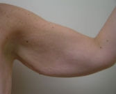 Feel Beautiful - Arm reduction San Diego Case 2 - Before Photo
